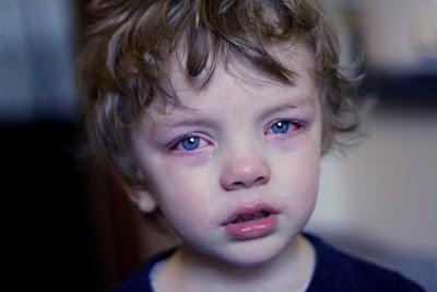 Црвени оци код детета: узроци, лечење и превенција