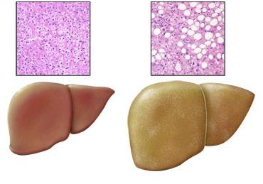 гојазност јетре него за лечење
