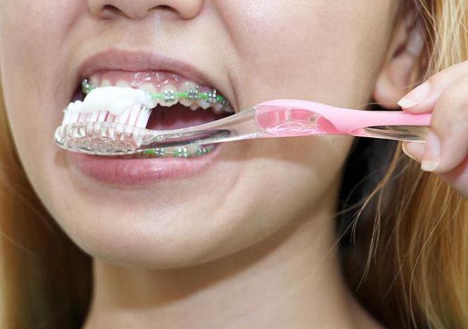 Плоче за поравнање зуба: преглед стоматолога и пацијената